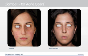 trattamento laser per acne