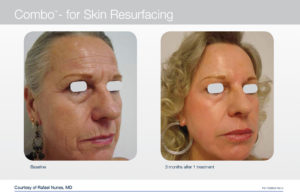 trattamento laser per viso