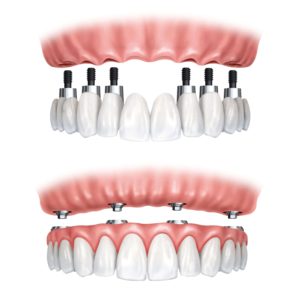 implantologia denti