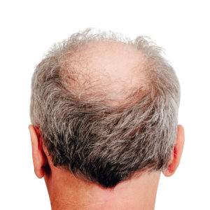 alopecia androgenetica uomo