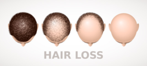 perdita capelli fase uomo